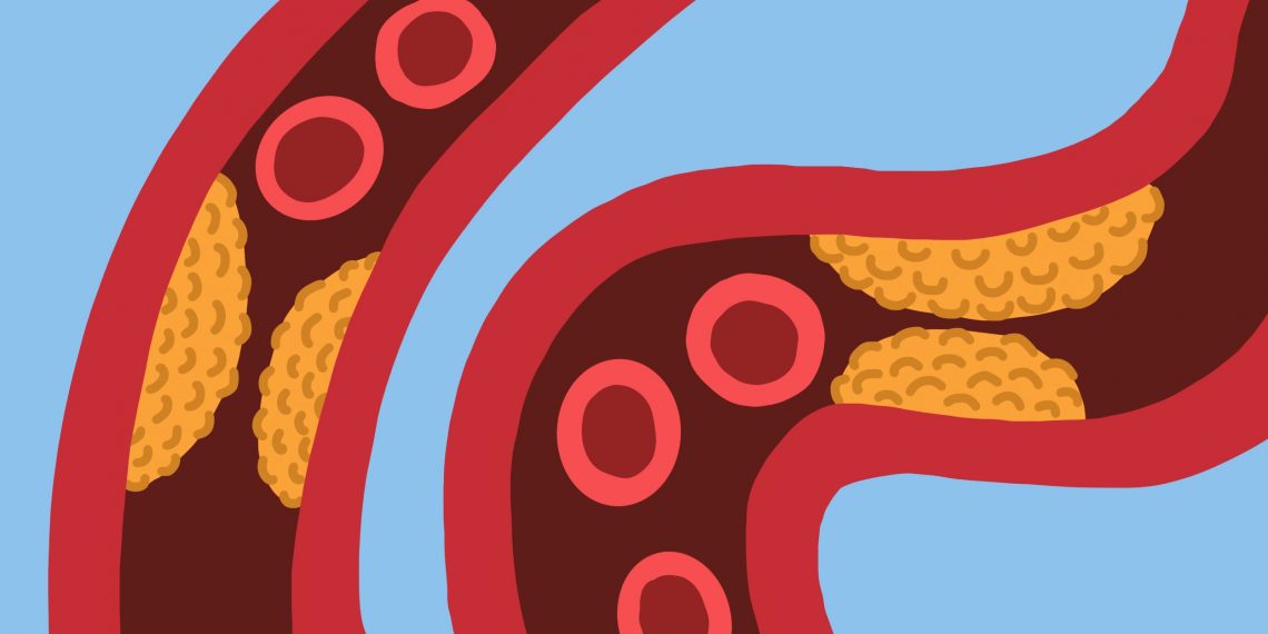 hoge cholesterol als gevolg